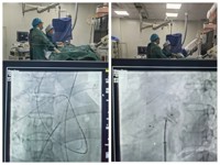 给患者“心”的未来 | 河西学院附属张掖人民医院成功实施张掖首例“室间隔缺损合并卵圆孔未闭一站式介入封堵术”